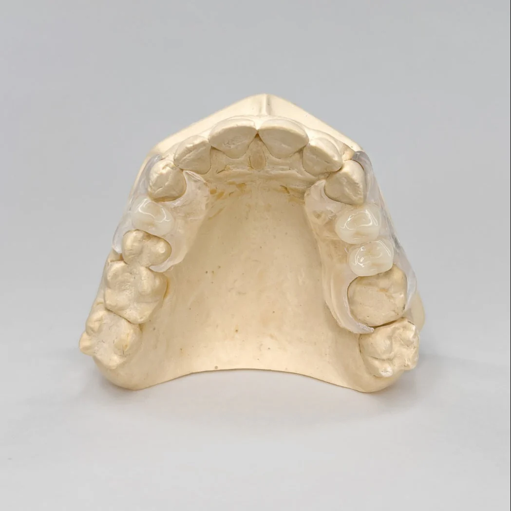 Clear Unilateral Partial Denture - Image 6