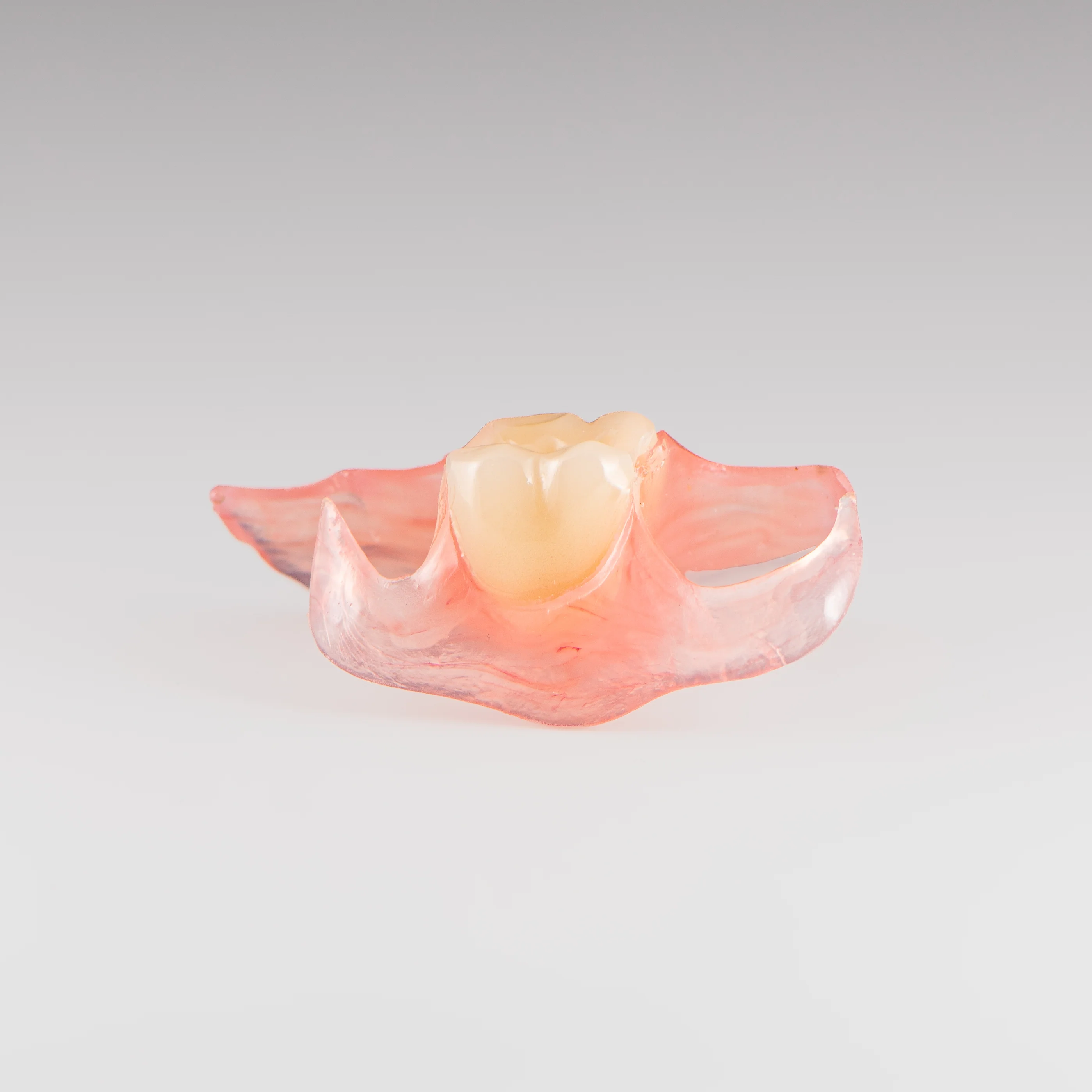 Unilateral Partial Denture - Image 4